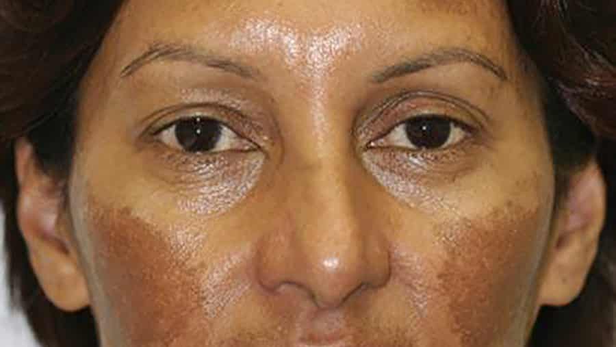 Hormonal Pigmentation: Why It Resists Conventional Treatment in Indian Skin