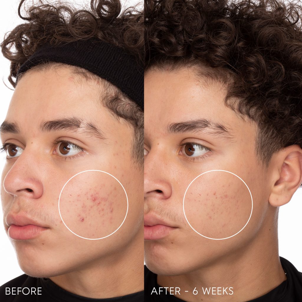 DermaClear Serum