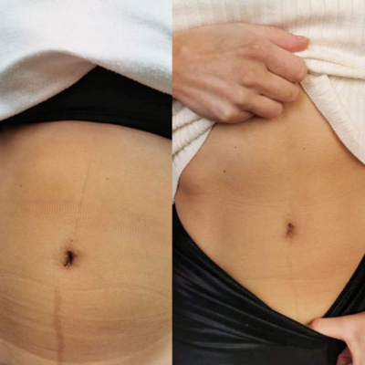 BioRePeel Body