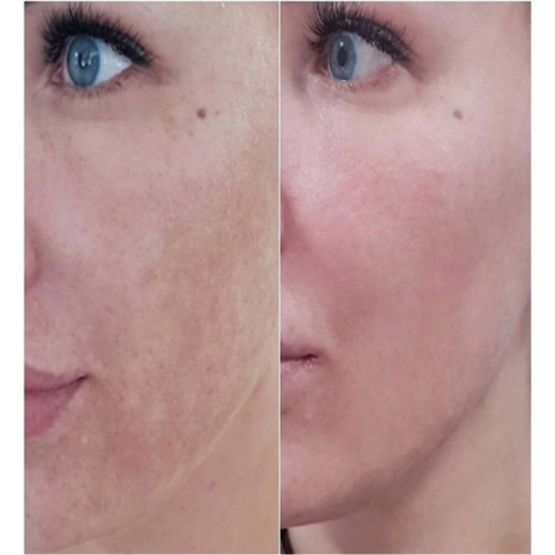 BioRePeel FND - Patented Formulation