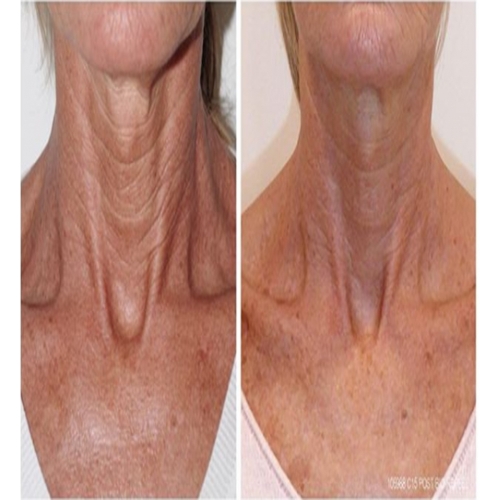 BioRePeel FND - Patented Formulation