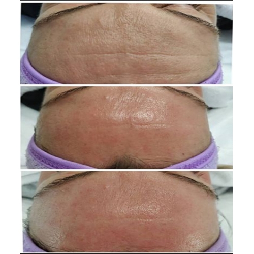 BioRePeel FND - Patented Formulation