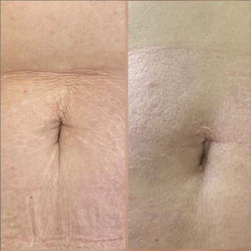 BioRePeel BODY - Patented Formulation