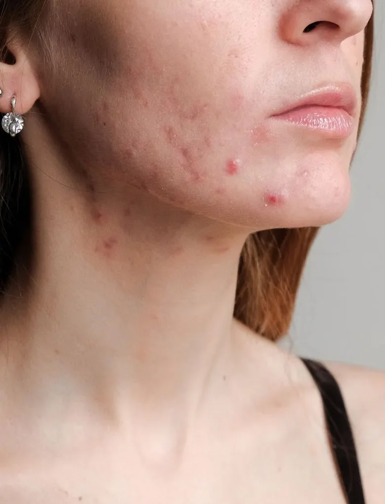 Acne
