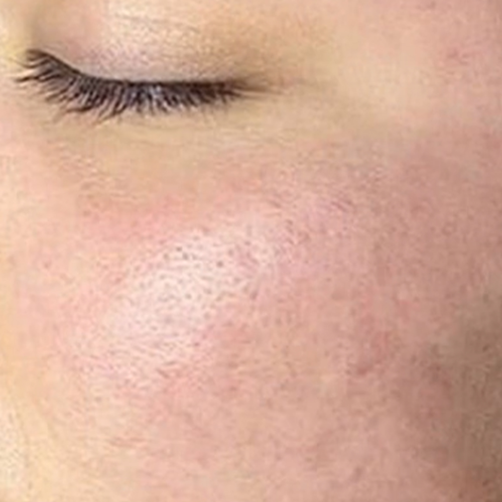 acne