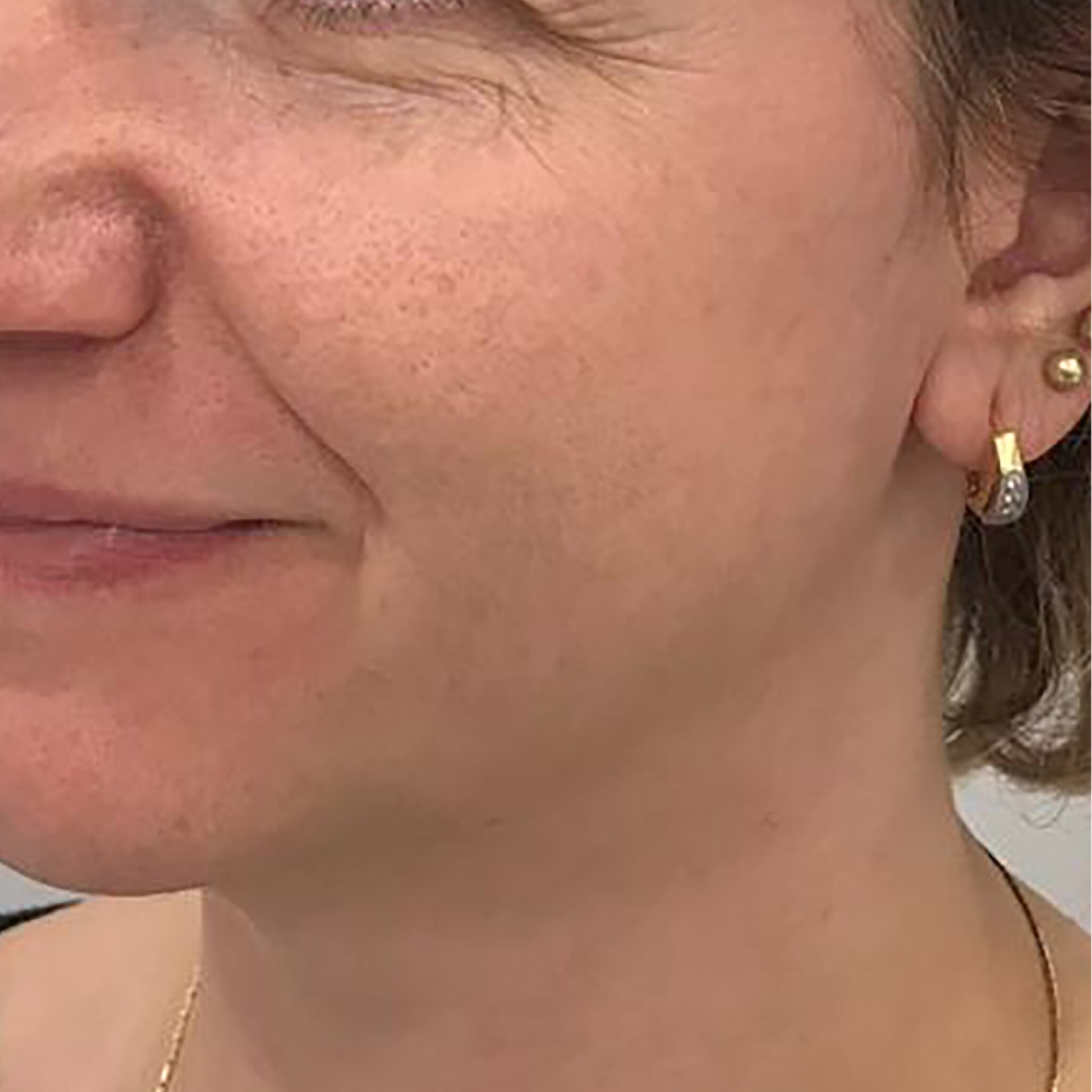 pigmentation