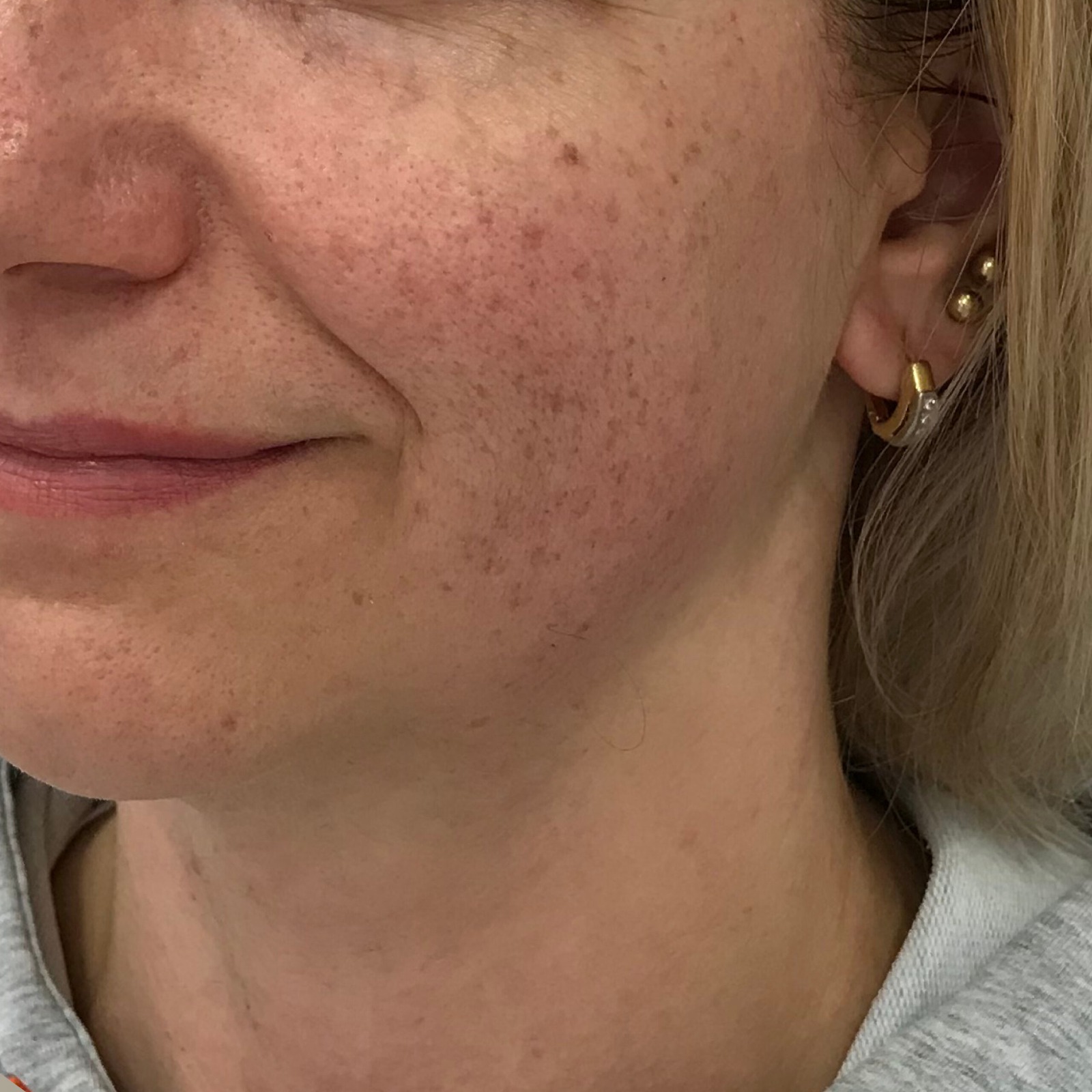 pigmentation