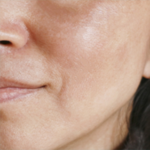 HYPERPIGMENTATION