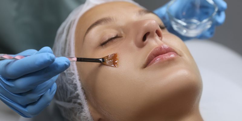 What Is Chemical Peeling?