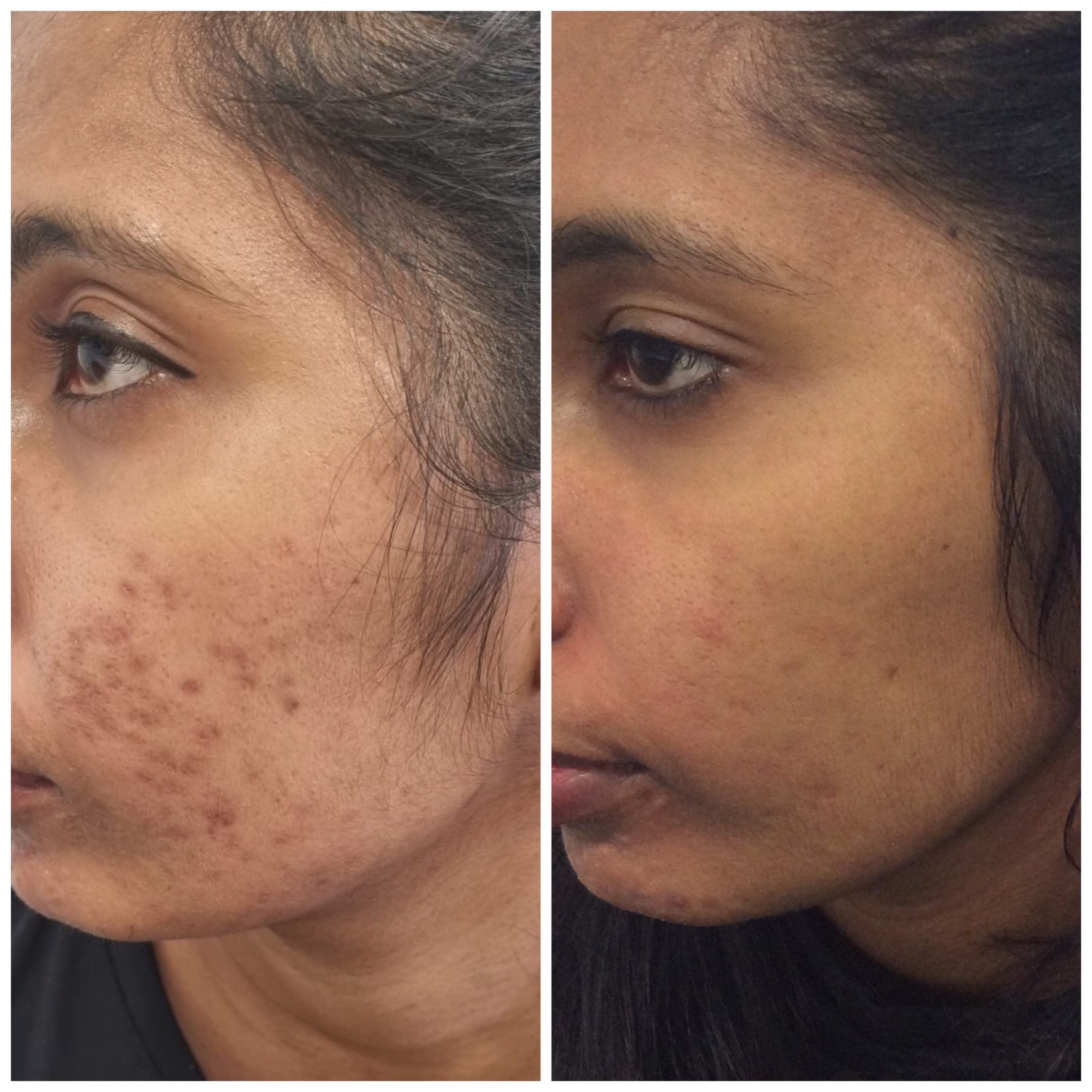 Dermaquest Peels & Resurfacer