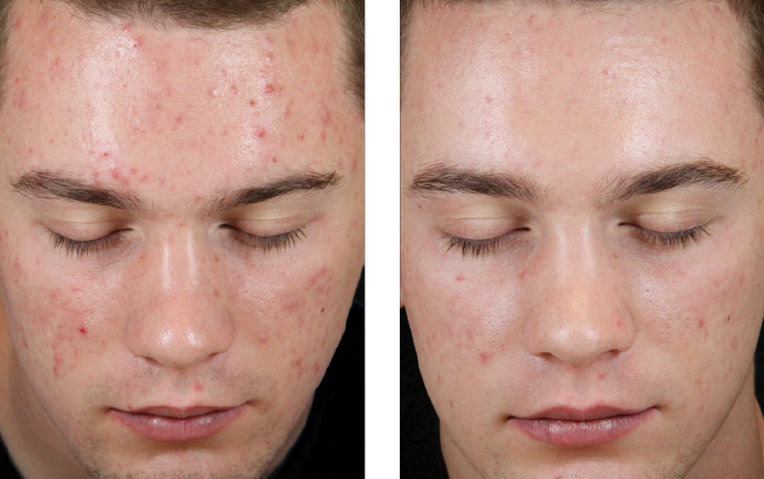 Acne Reduction Result