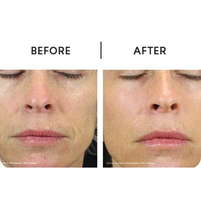 Power Peptide Resurfacer