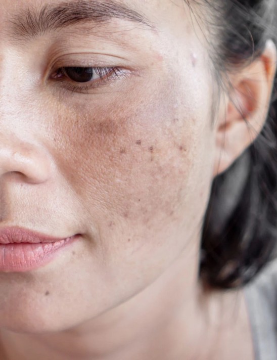 Melasma