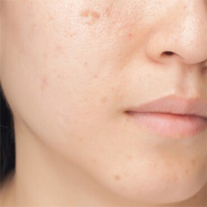 ACNE SCARS