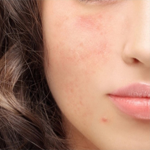 ROSACEA